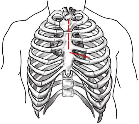 Schematic Diagram Of L Shaped Incision In Partial Upper Sternotomy