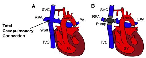Cavopulmonary Assist Device For Fontan Patients Meduni Wien