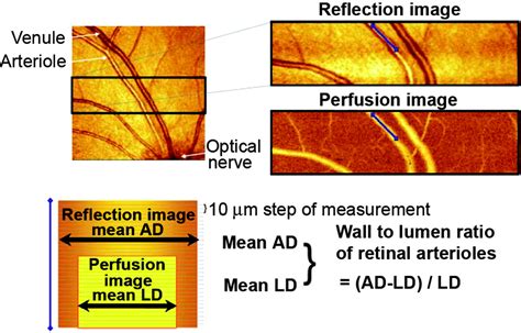 Hypertensive Retinopathy Hypertension