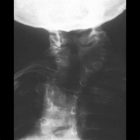 Klippel-Feil Syndrome | Pediatric Radiology Reference Article ...