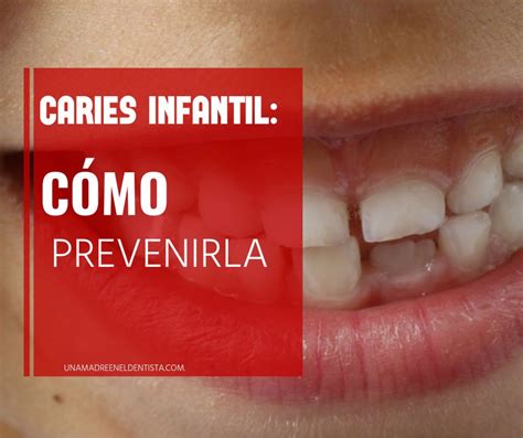 Nuevo Post Caries infantil cómo prevenirla Apunta los consejos de