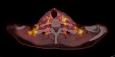 Brown Fat On PET Radiology Case Radshare Net