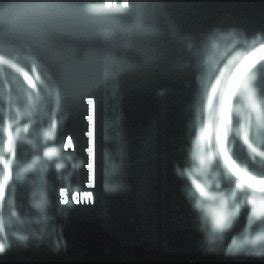 Mri Brain Showing The Cystic Nature Of Giant Occipital Encephalocele