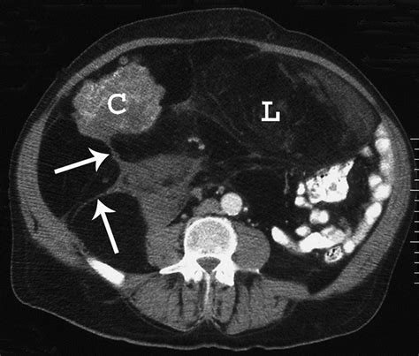 Imaging Of Musculoskeletal Liposarcoma With Radiologic Pathologic