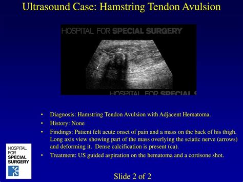 Ultrasound Case Hamstring Tendon Avulsion Ppt Download