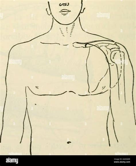 Modern Surgery General And Operative Fig 1053—disarticulation At