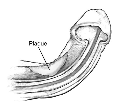 Cross Section Of A Curved Penis During Erection With Label For Plaque Media Asset Niddk