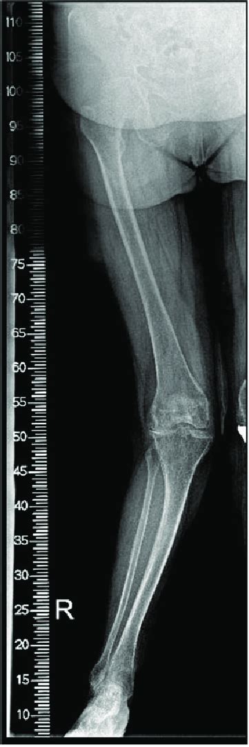 A Preoperative Long Standing Anteroposterior Radiograph Of The Lower