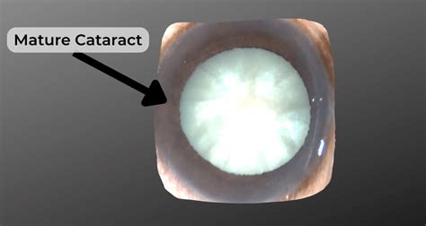 How Long Does Cataract Surgery Take Best Cataract Surgeons In America