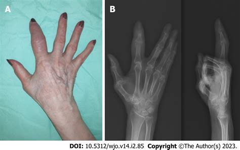 New Classification For Septic Arthritis Of The Hand