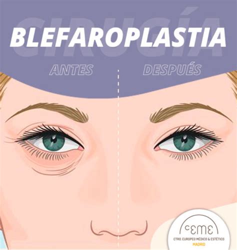 Razones Para Realizar Una Blefaroplastia O Cirug A De P Rpados Ceme