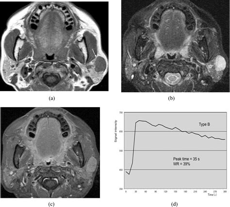 Figure 2 From Differentiating Benign And Malignant Salivary Gland