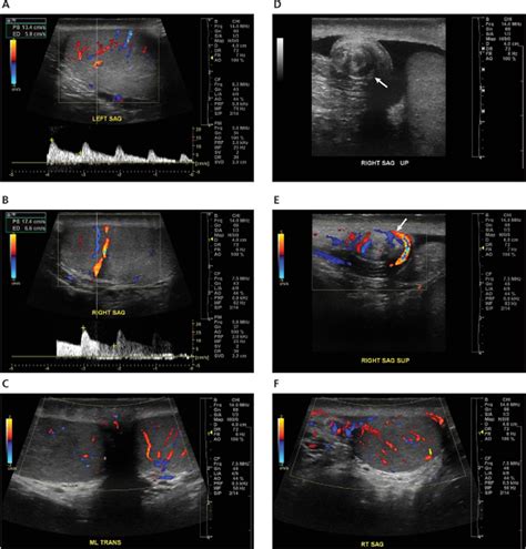 Role Of Spectral Doppler Sonography In The Evaluation Of Partial Testicular Torsion Cassar