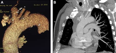 Successfully Kissing Stent Of Innominate Artery And Left Common Carotid