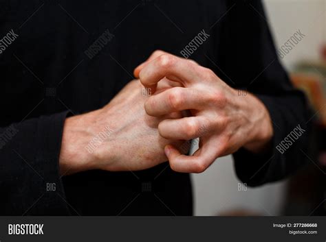 Psoriatic Nail Disease Image & Photo (Free Trial) | Bigstock