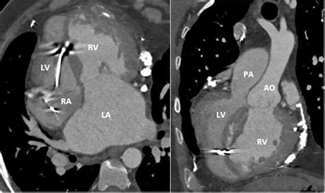 Ccta Image Demonstrating Parallel Great Vessels Consistent With Cctga