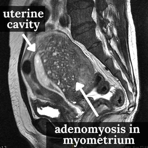 Endometriosis Imaging Mri At Lisa Bean Blog