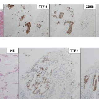 Pathological Findings A The Second Biopsy Sample Shows Combined Small