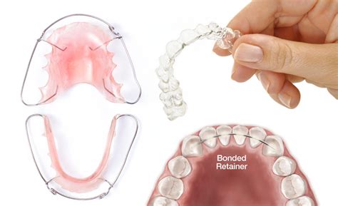 Orthodontic Retention Natural Smiles