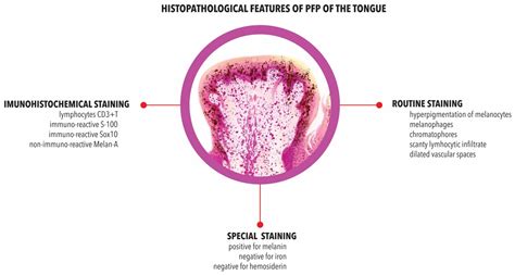 papules on tongue 4
