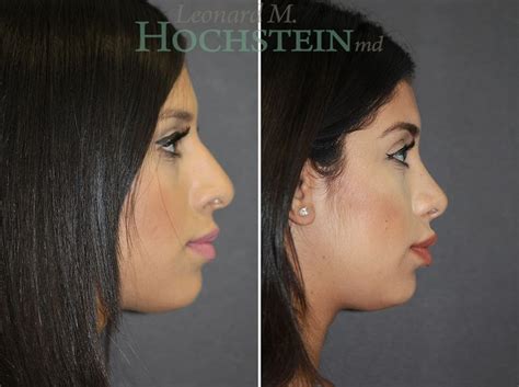 Rhinoplasty Surgery Nose Surgery Miami Fl Dr Leonard Hochstein