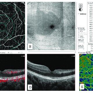 Central retinal artery occlusion with sparing of the cilioretinal ...