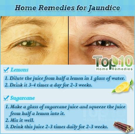 Home Remedies for Jaundice | Top 10 Home Remedies