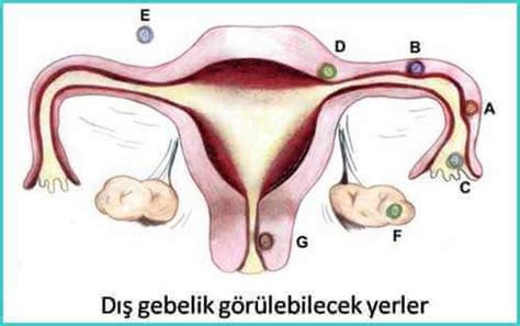 Ektopik Dış Gebelik Prof Dr Ali Rüştü Ergür