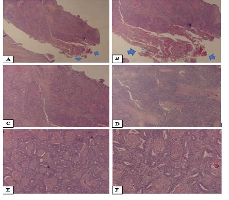 PDF Clear Cell Carcinoma Arising On The Surface Of Atypical Pol