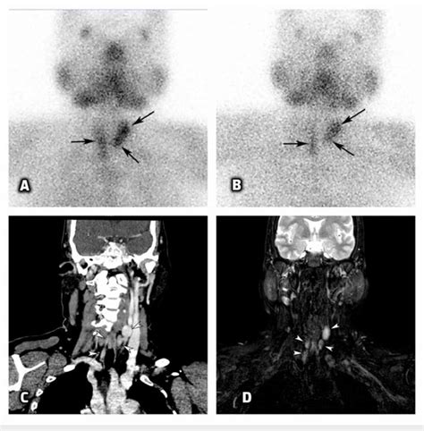 Technetium M Sestamibi A B D Ct C And D Mri D Scans Of The