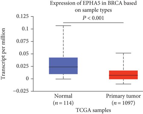 Transcriptional Levels Of Epha Efna In Breast Cancer And Paracancerous