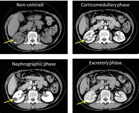 Calyceal Diverticulum Radiology Cases