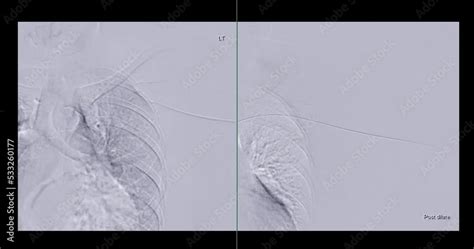 Angiogram Balloon Dialysis Catheter Inflated At Arteriovenous Av