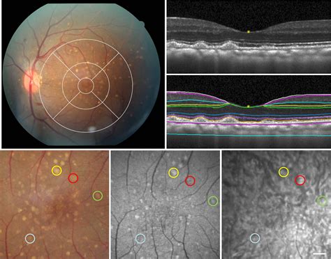 Imaging In Retinal Diseases