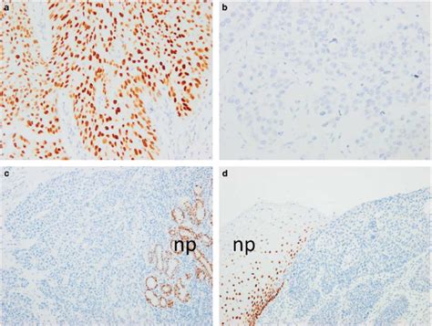 Sox2 Immunostaining In Squamous Cell Carcinomas Of The Esophagus A