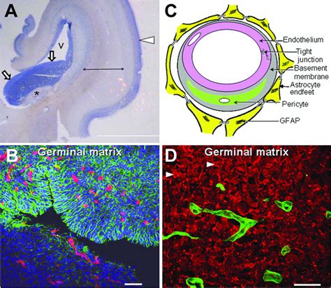 Germinal Matrix Hemorrhage Causes Symptoms Diagnosis Treatment