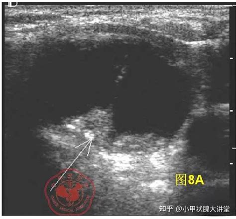 如何理解甲状腺结节钙化，血流丰富？ 知乎