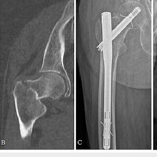 (A) Radiograph of a two-part basicervical fracture in a 91-year-old ...