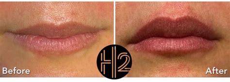 Liplase Non Invasive Lip Treatment For Fuller And Smoother Lips