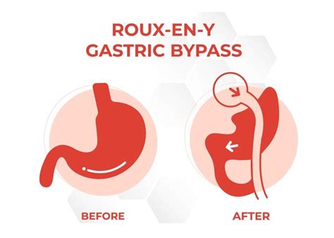 Premium Vector | Gastric bypass rny weight loss surgery vector illustration icon rouxeny