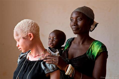 Beautiful People With Albinism