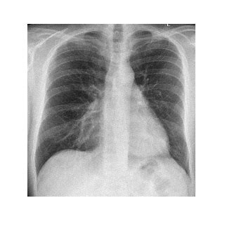 Frontal Chest X Ray Emergucate