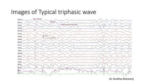 Triphasic Waves In Eeg