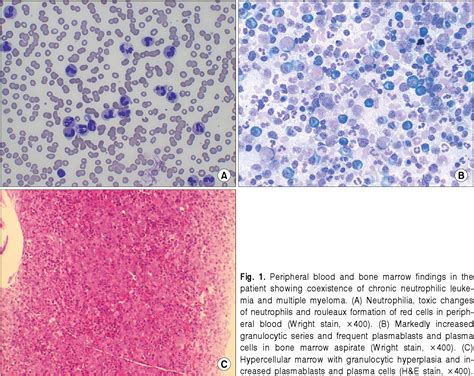 Figure From A Case Of Chronic Neutrophilic Leukemia With Multiple