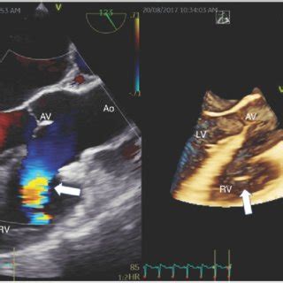 A Postoperative Transthoracic Echocardiography Long Axis Parasternal