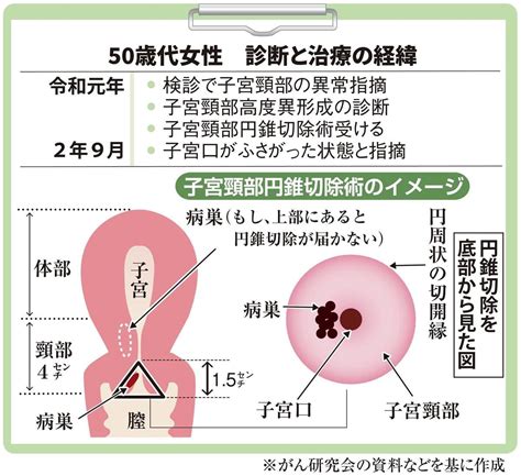 【がん電話相談から】子宮頸部高度異形成 子宮全摘出を提示された 産経ニュース