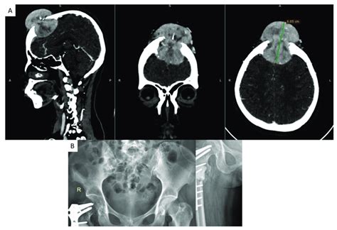 A Head Ct Scan Demonstrated A Skull Lesion In The Frontal Region With