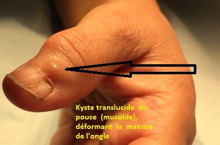 Kyste Poignet Doigt Et Kyste Mucoide Pathologies Et Operations Main