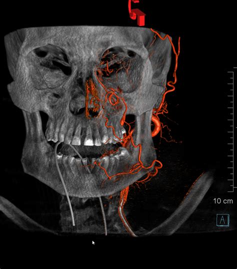 Facial Artery | neuroangio.org