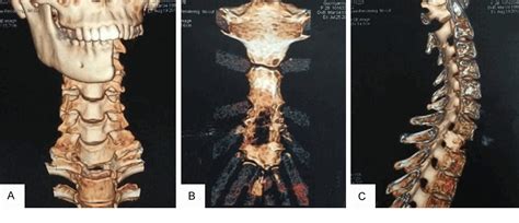 Figure 1 From Giant Cell Rich Osteosarcoma Of The Mandible With